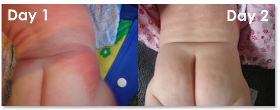 natural child baby eczema treatment