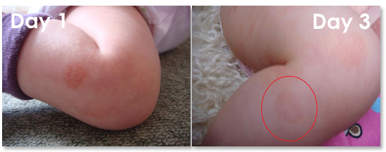 Infant Eczema Images