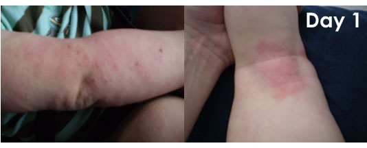 natural child baby eczema treatment